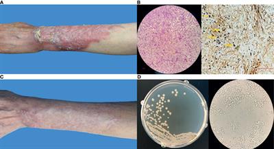 First Case of Subcutaneous Mycoses Caused by Dirkmeia churashimaensis and a Literature Review of Human Ustilaginales Infections